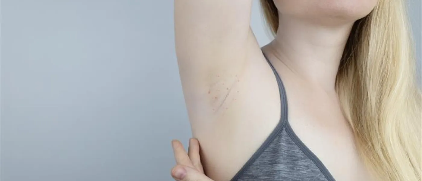 Suis-je allergique à ma transpiration ? 
